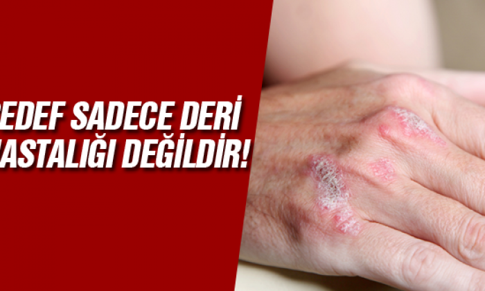 Sedef sadece deri hastalığı değildir!
