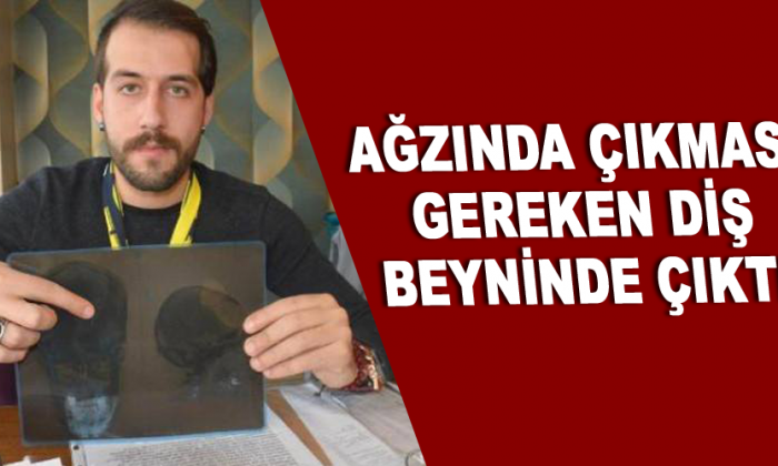 Ağzında Çıkması Gereken Diş Beyninde Çıktı
