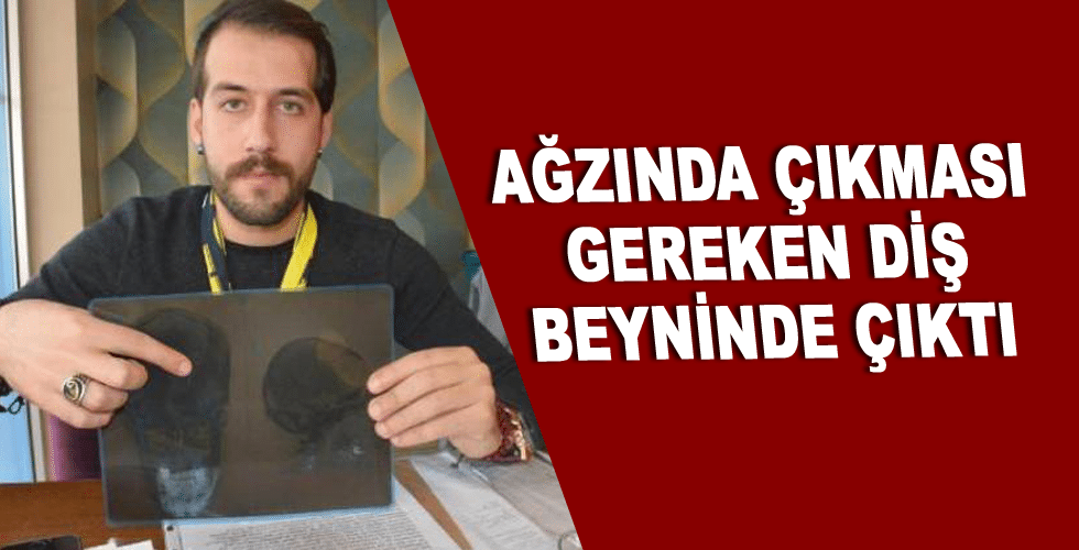 Ağzında Çıkması Gereken Diş Beyninde Çıktı