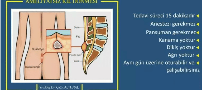 Kıl Dönmesi