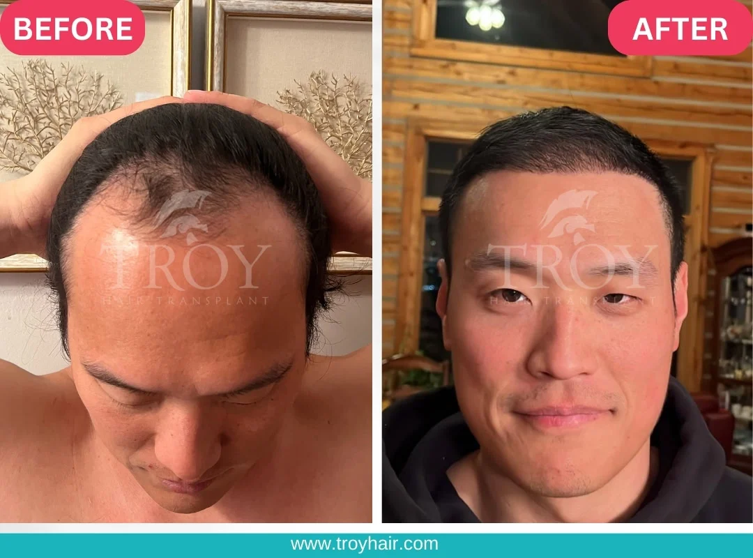 Türkiye’nin En İyi Hair Transplant Merkezi: Troy Hair