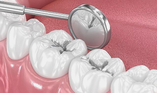 Amalgam Dolguların Değiştirilmesi Gerekliliği Hakkında